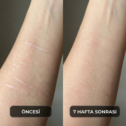 ClearMark İz Bakım Stiği — Akne, Ameliyat ve Çatlak İzleri