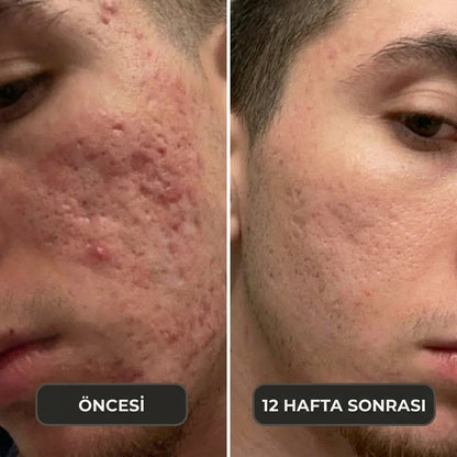 ClearMark İz Bakım Stiği — Akne, Ameliyat ve Çatlak İzleri